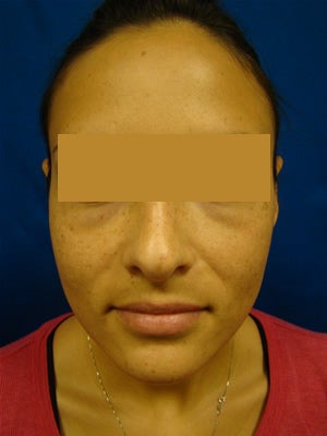 Ear Surgery (Otoplasty) after 167136