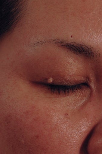 Skin Tag Removal Before Photo before 614134