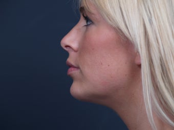 Chin Implant after 462482