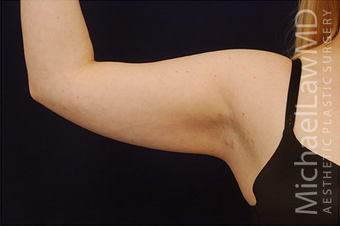 Liposuction 397154
