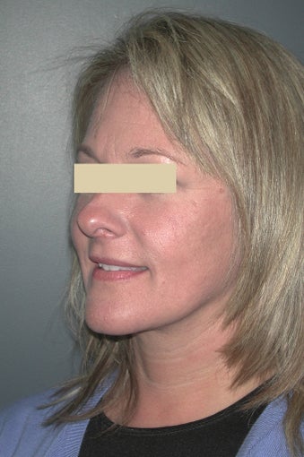 Facelift after 137047
