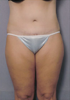 Tummy Tuck after 428193