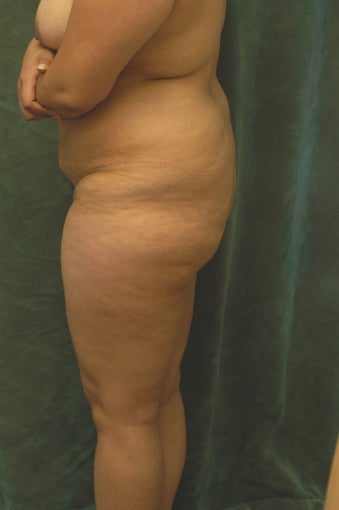 Buttocks Augmentation before 518110