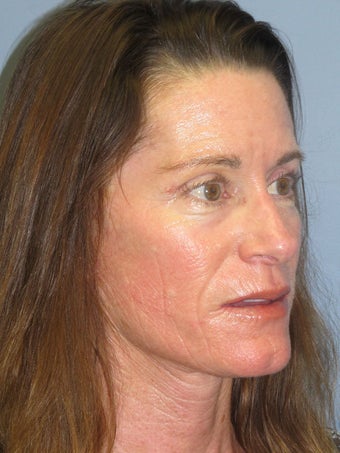 Obagi Blue Peel after 635061