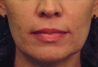 Laser Skin Tightening before 297813