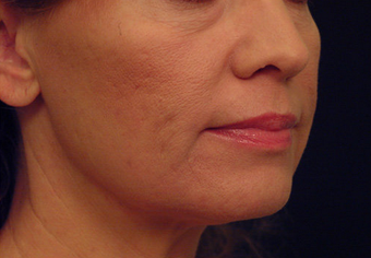 Yag Laser Skin Tightening 622085