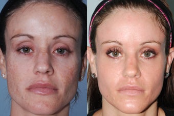 Fraxel Restore Dual Laser Treatments before 369114