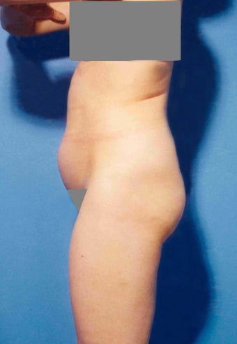 Abdominoplasty before 356387