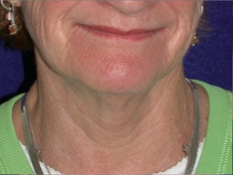 Necklift before 208438