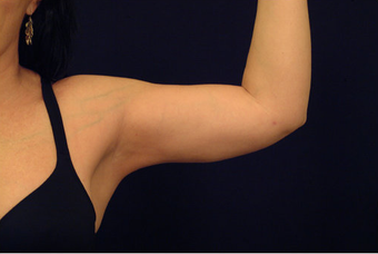 Liposuction after 393227