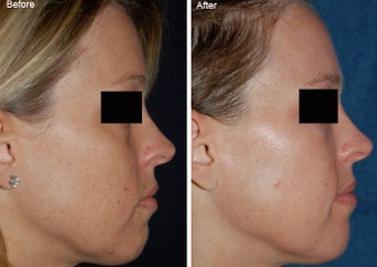Fraxel Laser Resurfacing before 97891