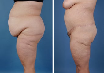 Bilateral Lower Body Lift and Liposuction after 303678