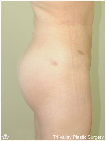 Brazilian Buttock Lift after 420873
