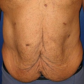 Body Lift before 95741