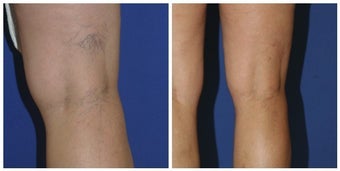 Sclerotherapy before 392706