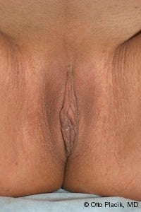 Labiaplasty 571748