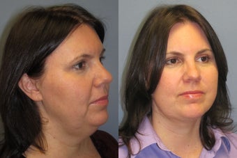 Lite Lift™, liposuction of the neck before 523705