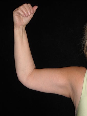 Arm lift (brachioplasty) after 359323