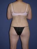 Thigh Lift after 329952