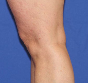 VASER Shape to Legs after 433063