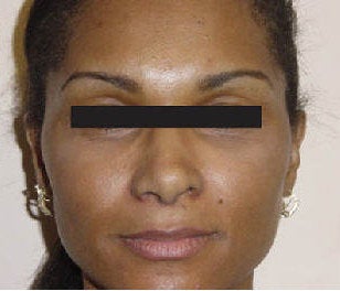 Rhinoplasty before 172974