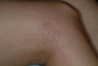 Sclerotherapy after 86808