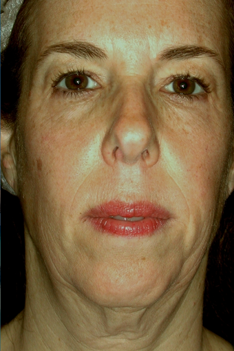 Affirm CO2 Laser before 200606