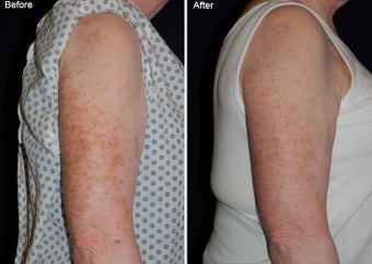 Fraxel laser resurfacing before 97761