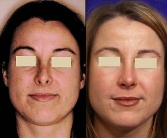 Revision Rhinoplasty before 127036