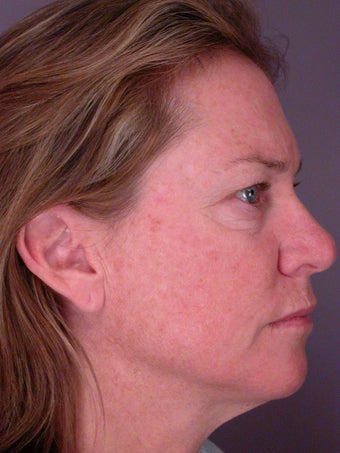 Neck Lift before 306409