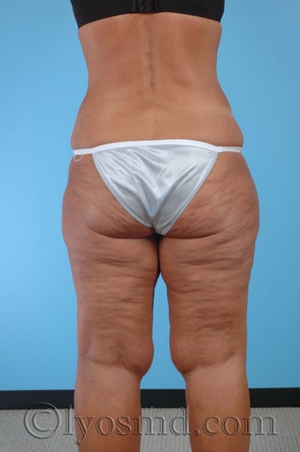 Lower Body Lift, Inner Thigh Lift before 255921