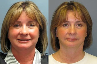 Lite Lift, liposuction of the neck after 523486