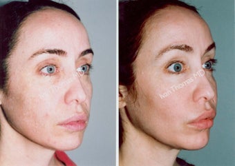 Non-Surgical Face Lift- Exoderm before 242984