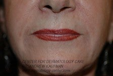 Dermal Filler Injection to Marionette and Accessory Smile Lines after 315163
