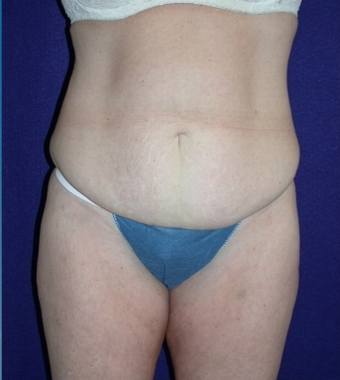 Tummy Tuck (abdominoplasty) before 208482