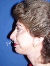 Chin Implants 622585
