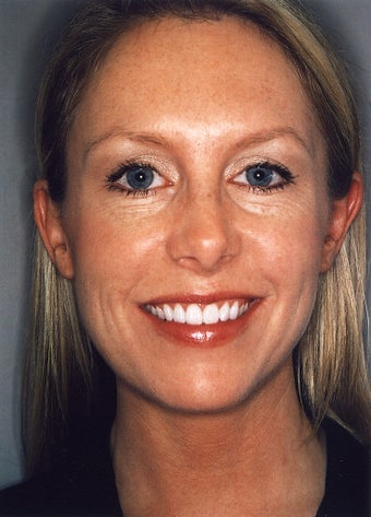 Botox after 628888