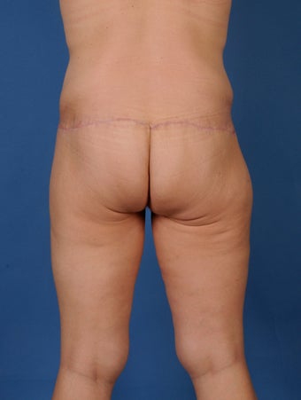 Buttock Lift after 504107