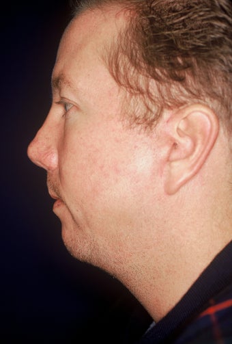 Chin Implant before 551169