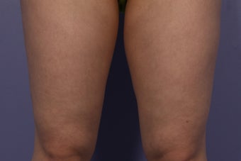 CoolSculpting Inner Thighs after 429659