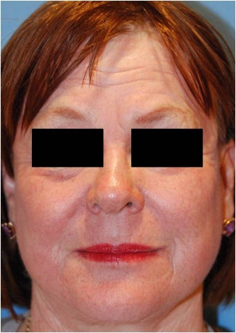 CO2 Laser Resurfacing ~ Active & Deep FX after 130742