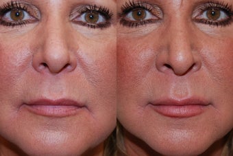 Silikon-1000 for Lip Augmentation and Marionette Grooves before 180094