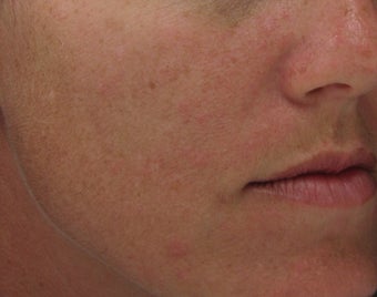 Hyperpigmentation treated with Obagi for 3 months before 52832