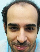 FUE – SFET Using Nape and Head Hair for conservative hairline before 196040