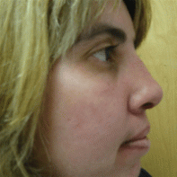 Revision Rhinoplasty 443001
