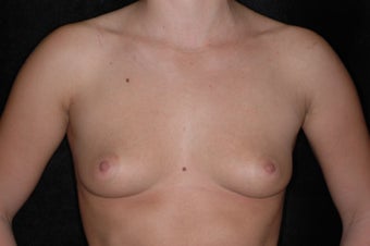 Breast Augmentation before 336380