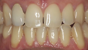 EMAX crown and extreme whitening treatment. before 349670