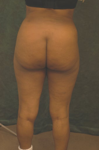 Women's Buttocks Augmentation 518126