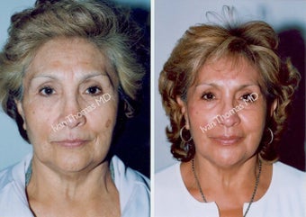 Non-Surgical Face Lift- Exoderm before 242991
