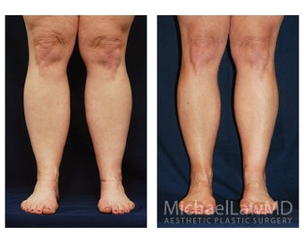 Liposuction before 397064
